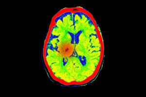 CT scan of brain axial showing cerebral blood flow